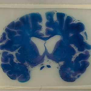 Blue myelin stain of brain displaying presence of multiple sclerosis